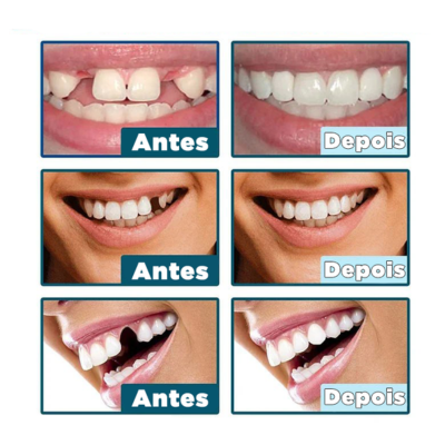 Facetas Dentárias Naturais Removíveis (Superior e Inferior) - SmileFit - Vinych