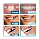 Facetas Dentárias Naturais Removíveis (Superior e Inferior) - SmileFit - Vinych