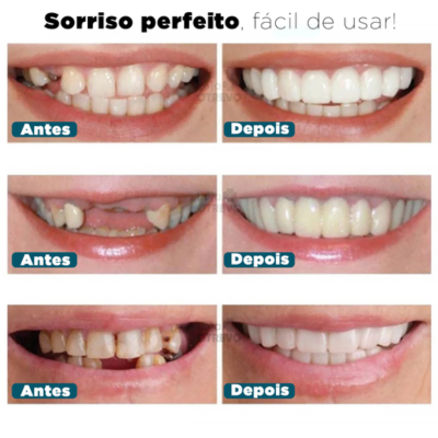 Facetas Dentárias Naturais Removíveis (Superior e Inferior) - SmileFit - Vinych