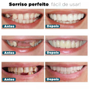 Facetas Dentárias Naturais Removíveis (Superior e Inferior) - SmileFit - Vinych